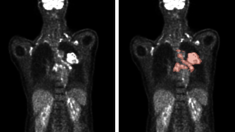 Image: Automated methods enable the analysis of PET/CT scans (left) to accurately predict tumor location and size (right) (Photo courtesy of Gatidis S, Kuestner T, Nature Machine Intelligence, 2024. DOI: 10.1038/s42256-024-00912-9)